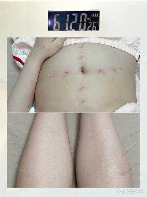 针灸减肥什么季节最合适