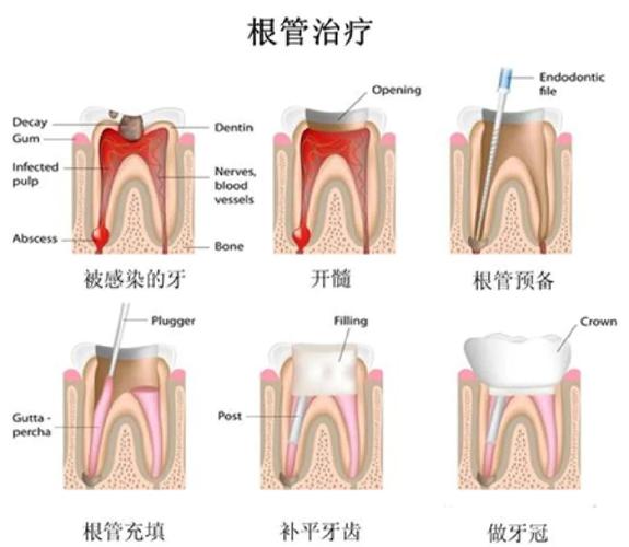 为什么要抽牙神经