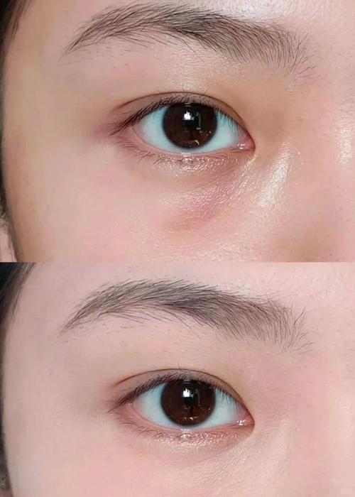 泪沟用什么填充好