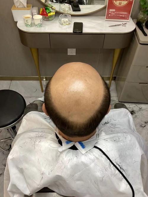 男人脱发是什么原因