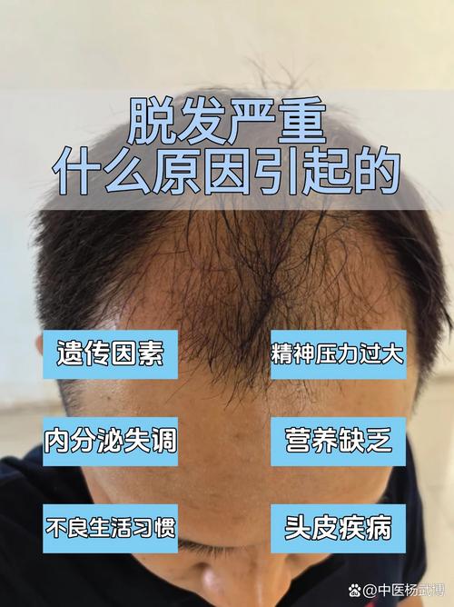 男人脱发是什么原因