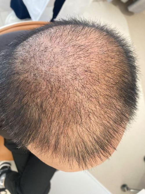 医院植发挂什么科