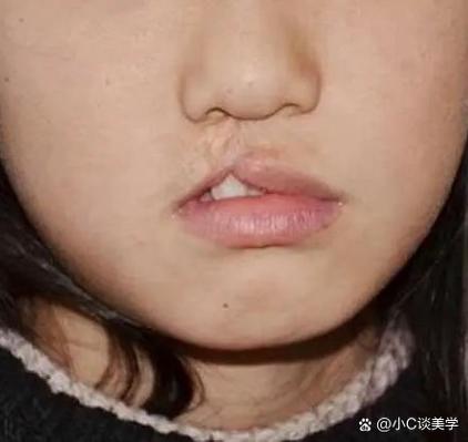兔唇是什么意思