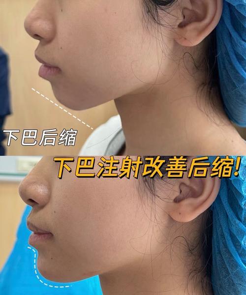 什么是丰下巴