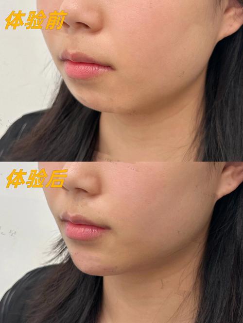 什么是丰下巴