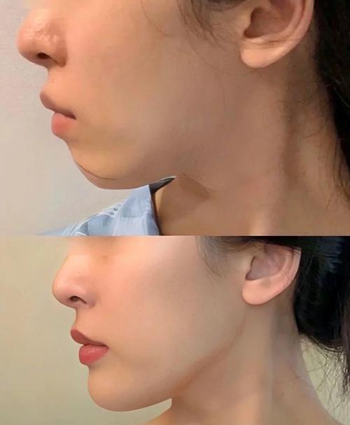 什么是丰下巴