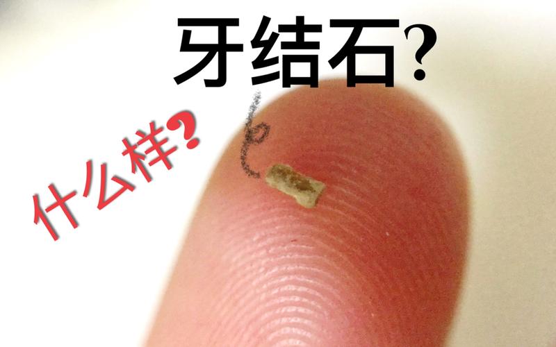牙结石是什么东西