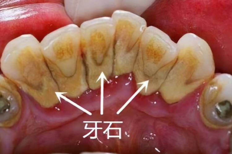 牙结石是什么东西