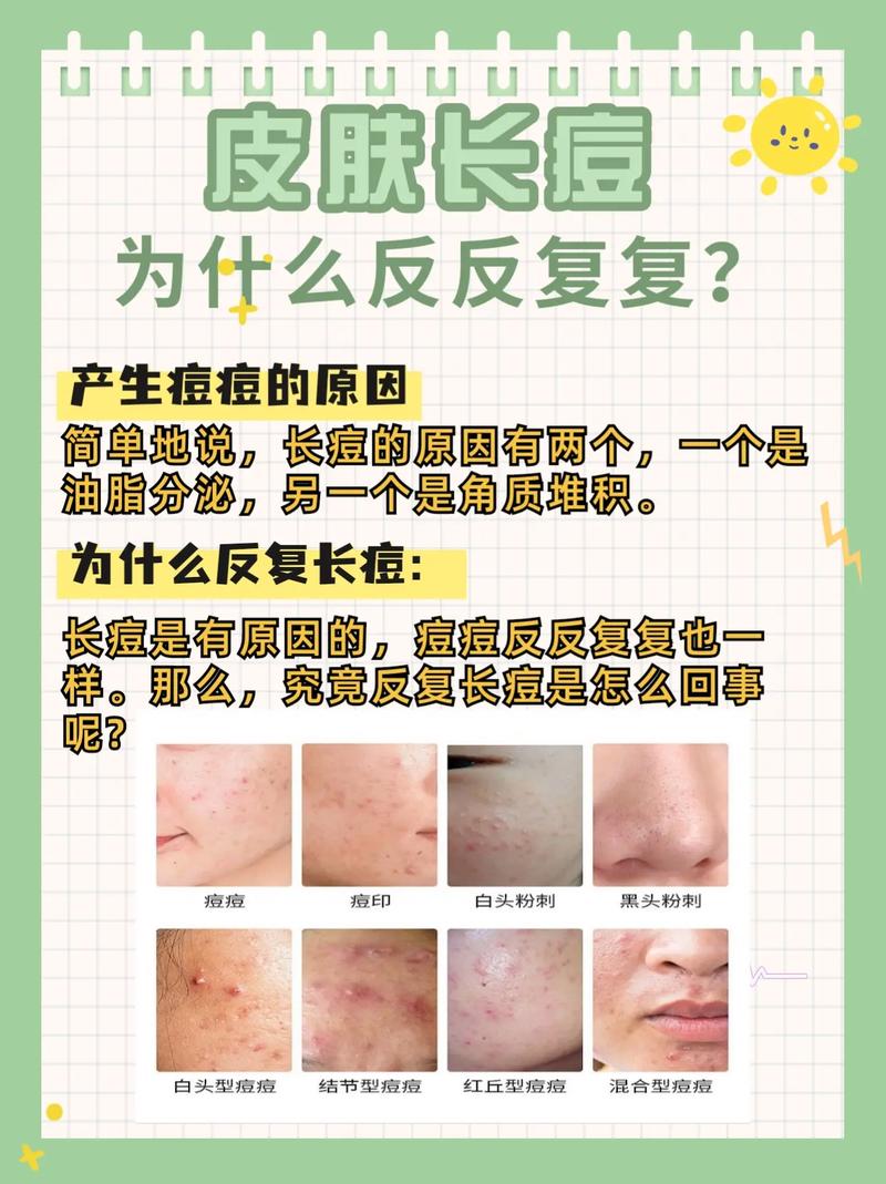 痘痘反复长什么原因
