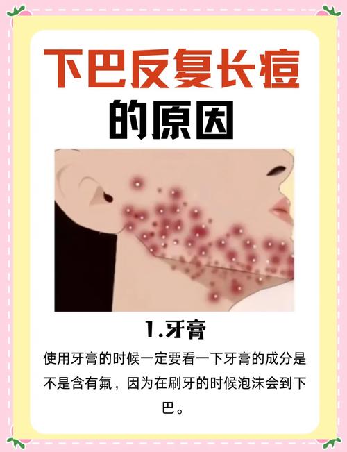 痘痘反复长什么原因