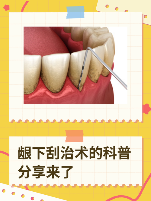 牙周刮治是什么