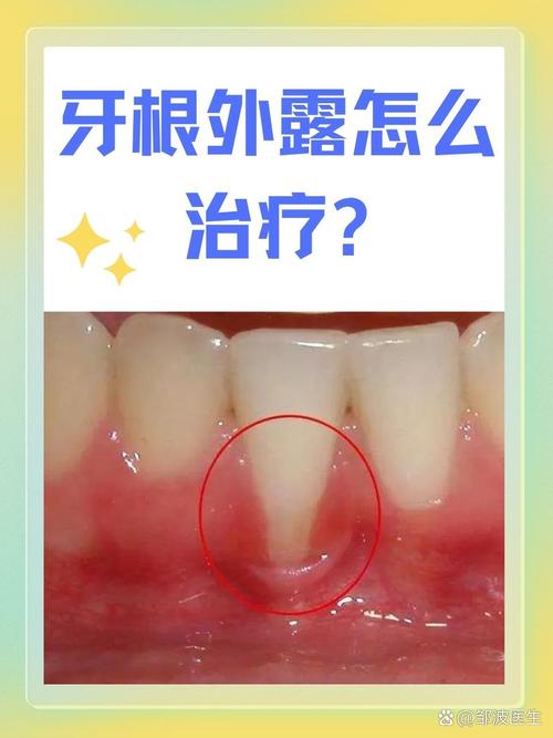 牙根为什么会发炎