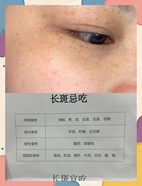 什么季节适合祛斑