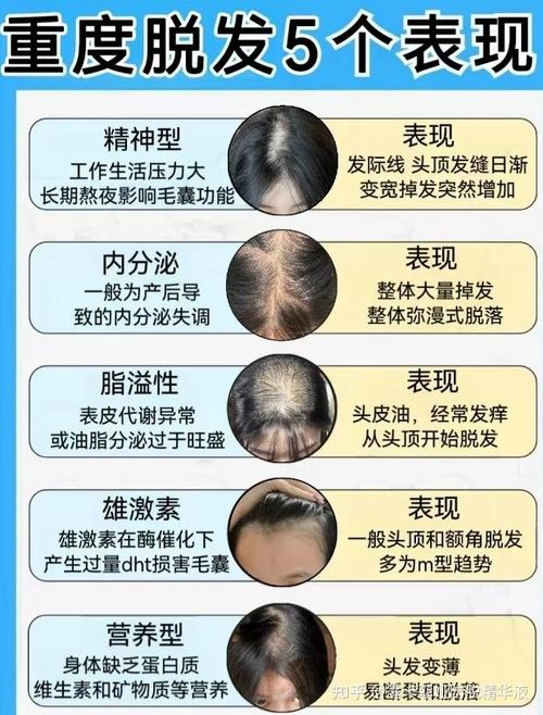 脱发应该看什么科