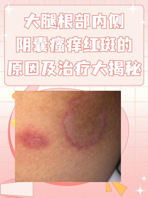 大腿根部痒是什么