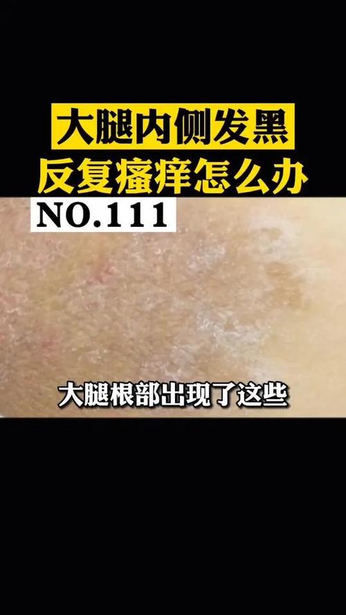 大腿根部痒是什么