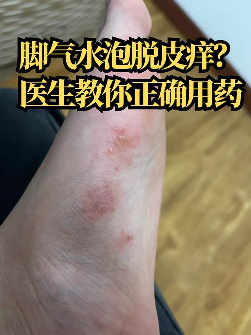 脚癣挂什么科