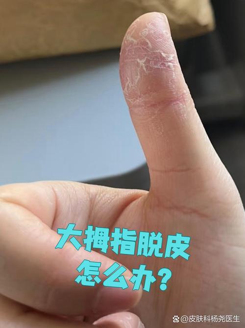 指甲起皮是什么原因