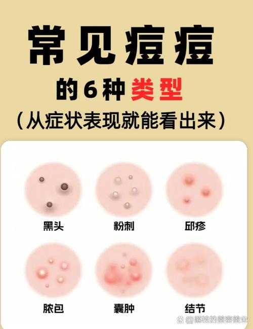 脸上痘痘为什么会痒