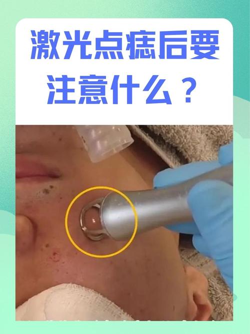 什么是激光点痣