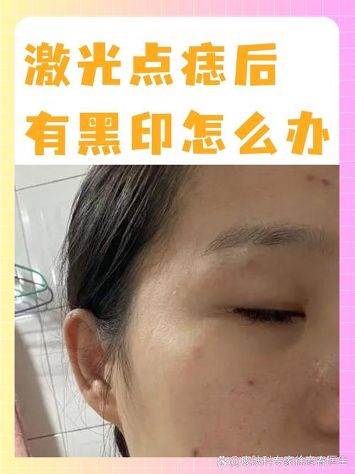 什么是激光点痣