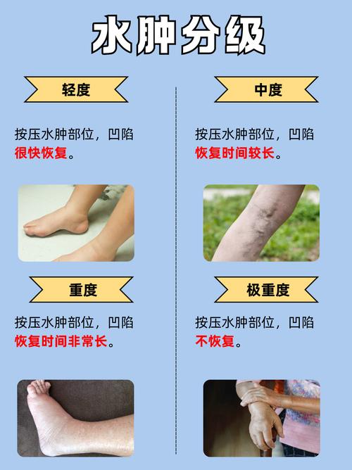 减肥水肿 为什么