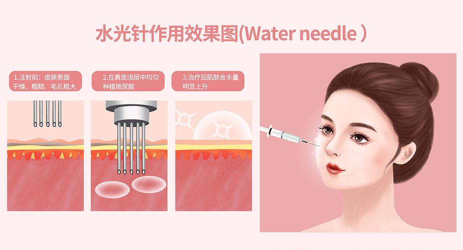 减肥水光针是什么