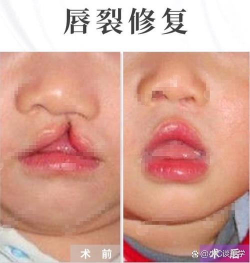兔唇长什么样