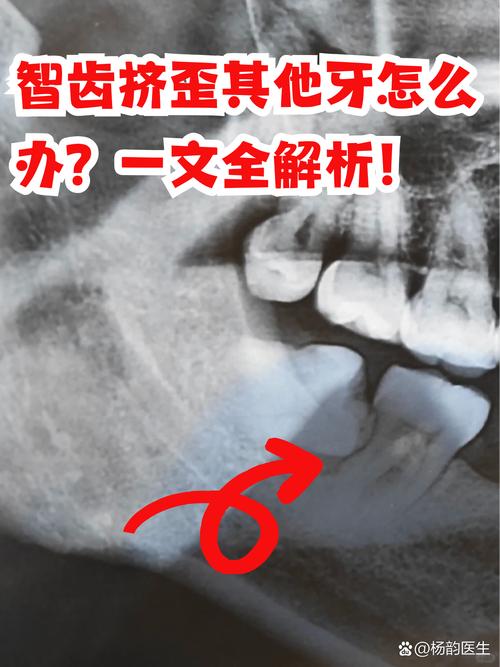 智齿为什么会长歪