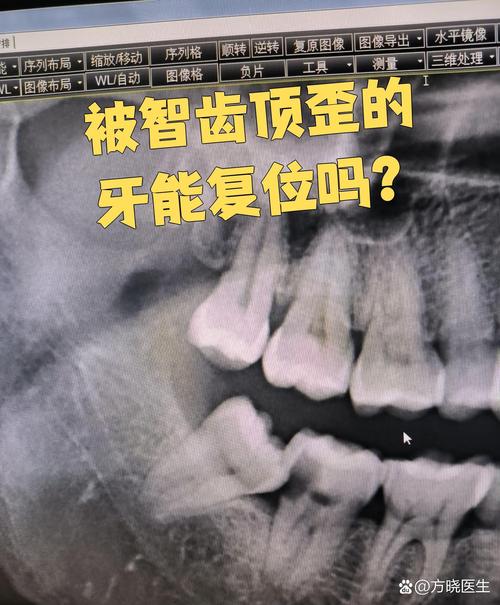 智齿为什么会长歪