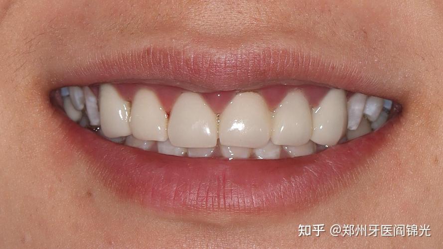 什么是前牙