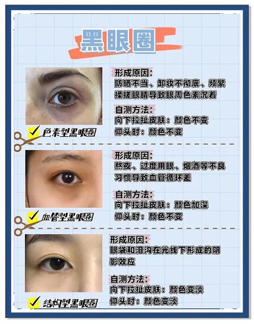 黑眼圈很重是什么原因