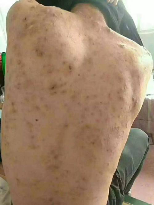 背部长痘是什么原因