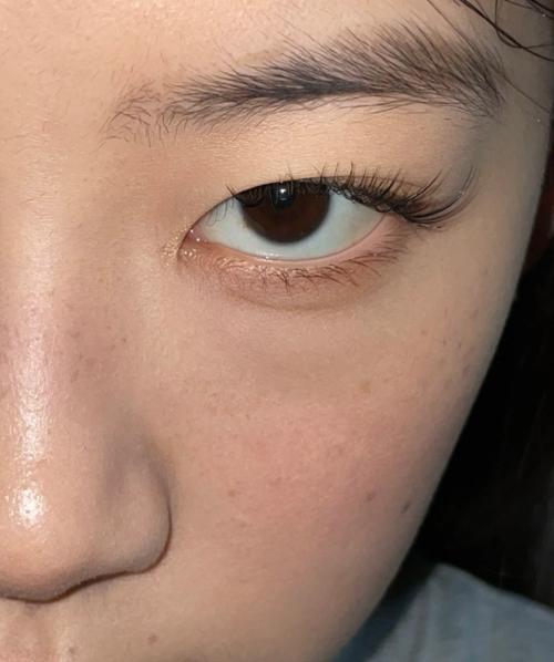 鼻子上的斑是什么斑