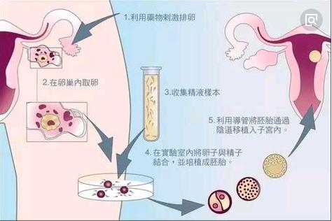 什么是自体移植