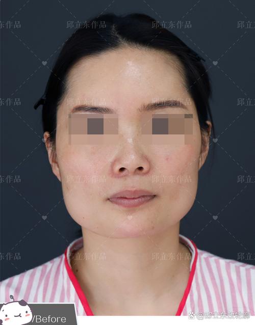 什么是颧骨宽
