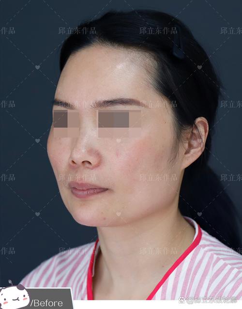 什么是颧骨宽