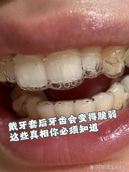 什么情况要带牙套
