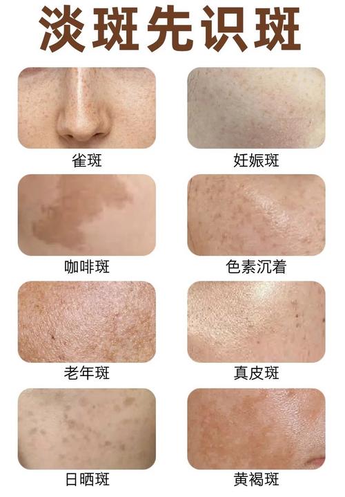 成片的斑是什么斑