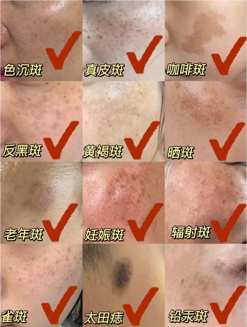 成片的斑是什么斑