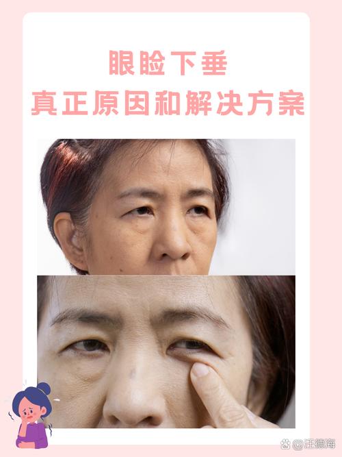 眼睛下垂是什么原因