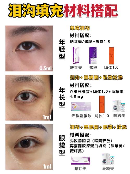 泪沟填充用什么好