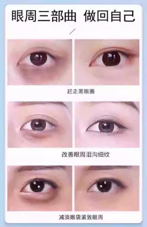泪沟填充用什么好