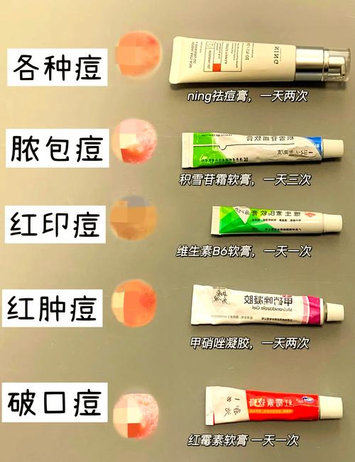 脸上粉刺用什么药膏
