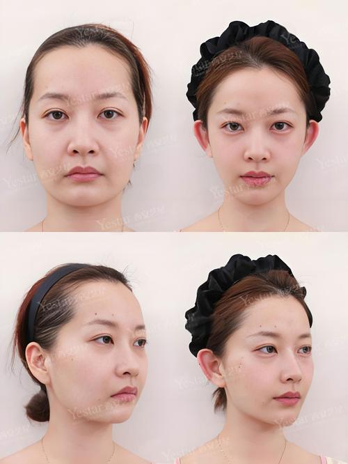 整容有什么副作用