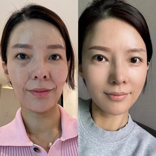 整容有什么副作用