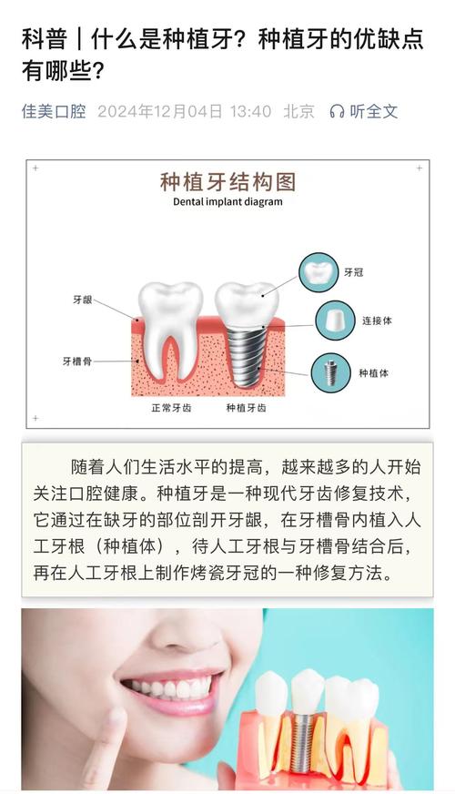 种植牙是什么原理