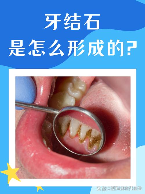 牙结石会导致什么
