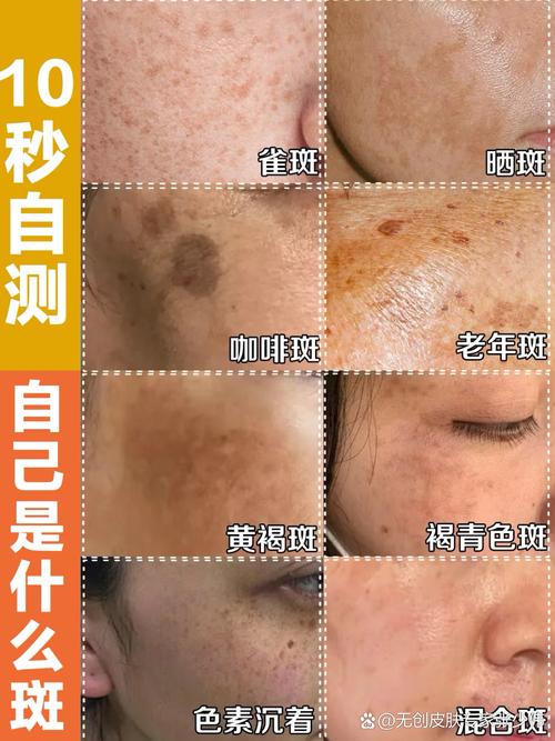 脸上都有什么斑