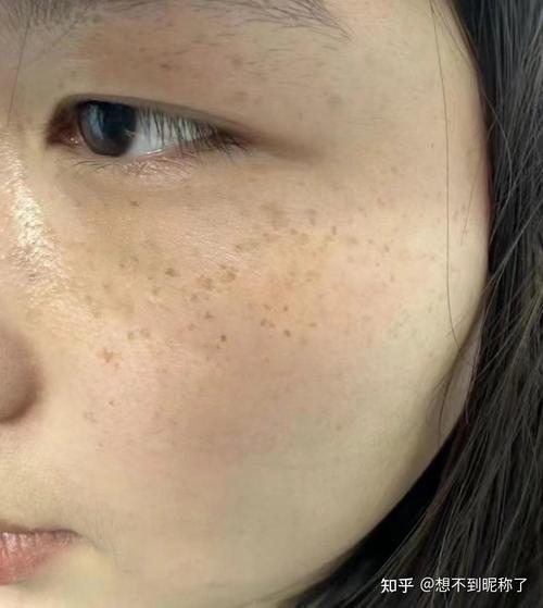 脸上都有什么斑